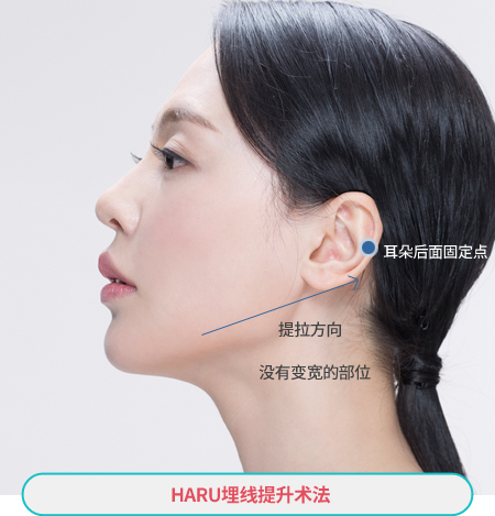 하루리프팅의 실리프팅 방식