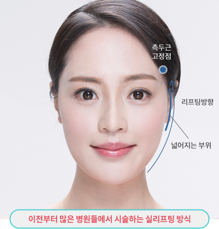 이전부터 많은 병원들에서 시술하는 실리프팅 방식