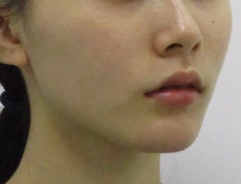 포인트v턱끝교정_턱끝교정_턱끝축소 (3).jpg
