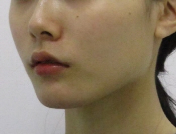 포인트v턱끝교정_턱끝교정_턱끝축소 (2).jpg