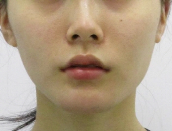 포인트v턱끝교정_턱끝교정_턱끝축소 (1).jpg