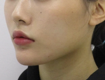 포인트v턱끝교정_턱끝교정_턱끝축소 (5).jpg