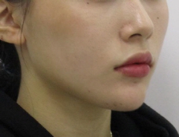 포인트v턱끝교정_턱끝교정_턱끝축소 (6).jpg